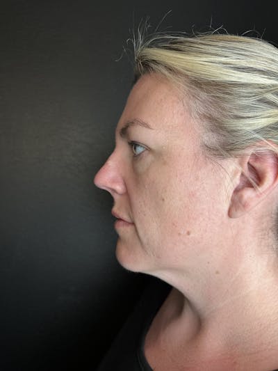 Lower Face Filler Before & After Gallery - Patient 370798 - Image 1