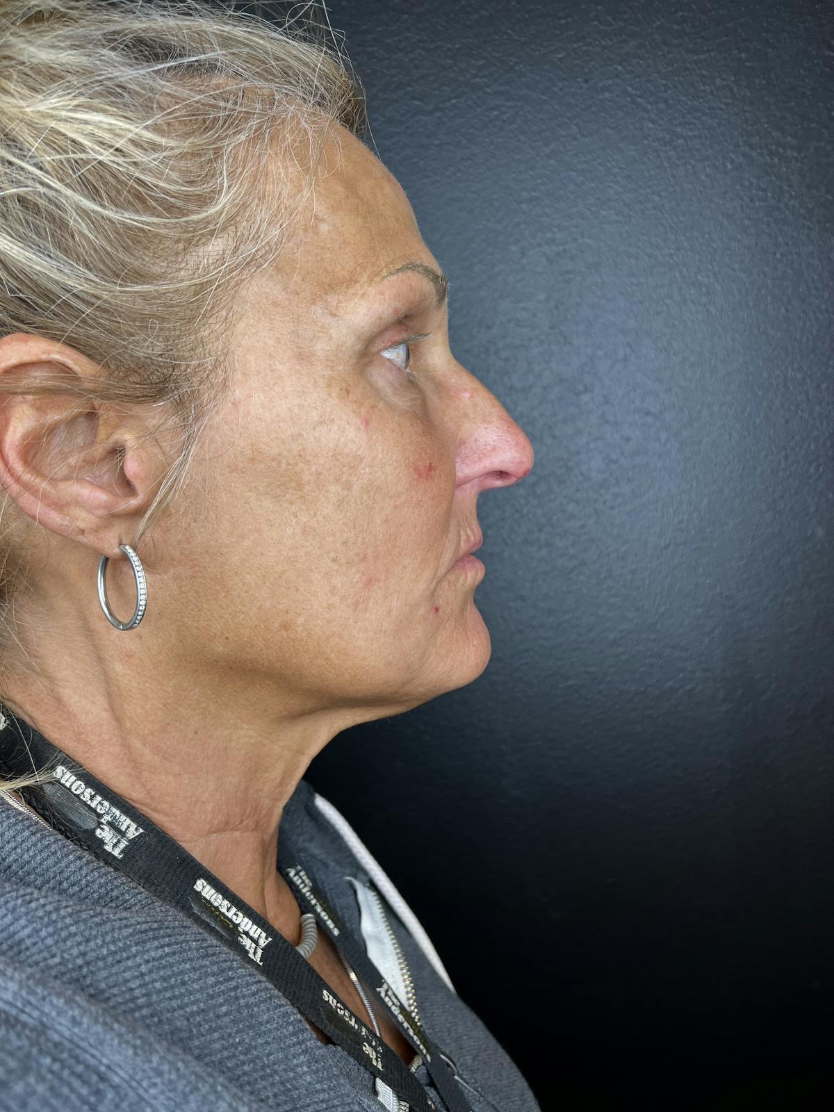 Lower Face Filler Before & After Gallery - Patient 877671 - Image 2
