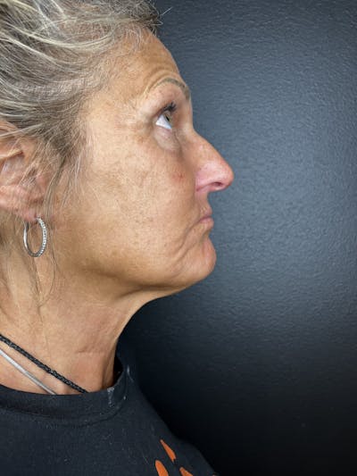 Lower Face Filler Before & After Gallery - Patient 877671 - Image 1