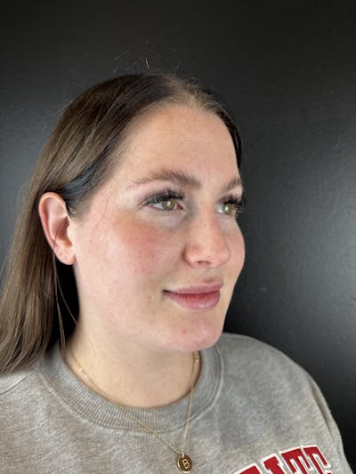 Lower Face Filler Before & After Gallery - Patient 104210 - Image 1