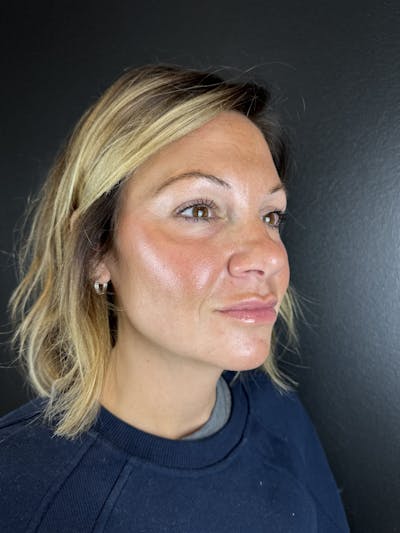 Full Facial Filler Before & After Gallery - Patient 323382 - Image 2