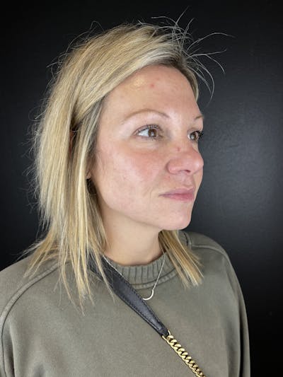 Full Facial Filler Before & After Gallery - Patient 323382 - Image 1