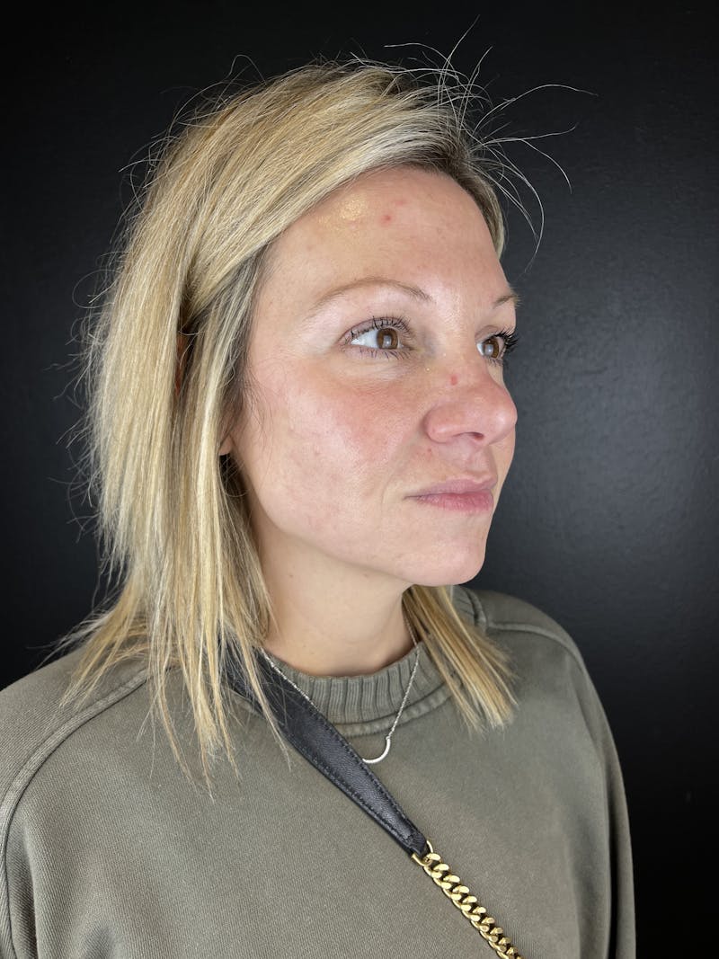 Full Facial Filler Before & After Gallery - Patient 323382 - Image 1