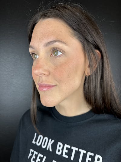 Full Facial Filler Before & After Gallery - Patient 353003 - Image 2