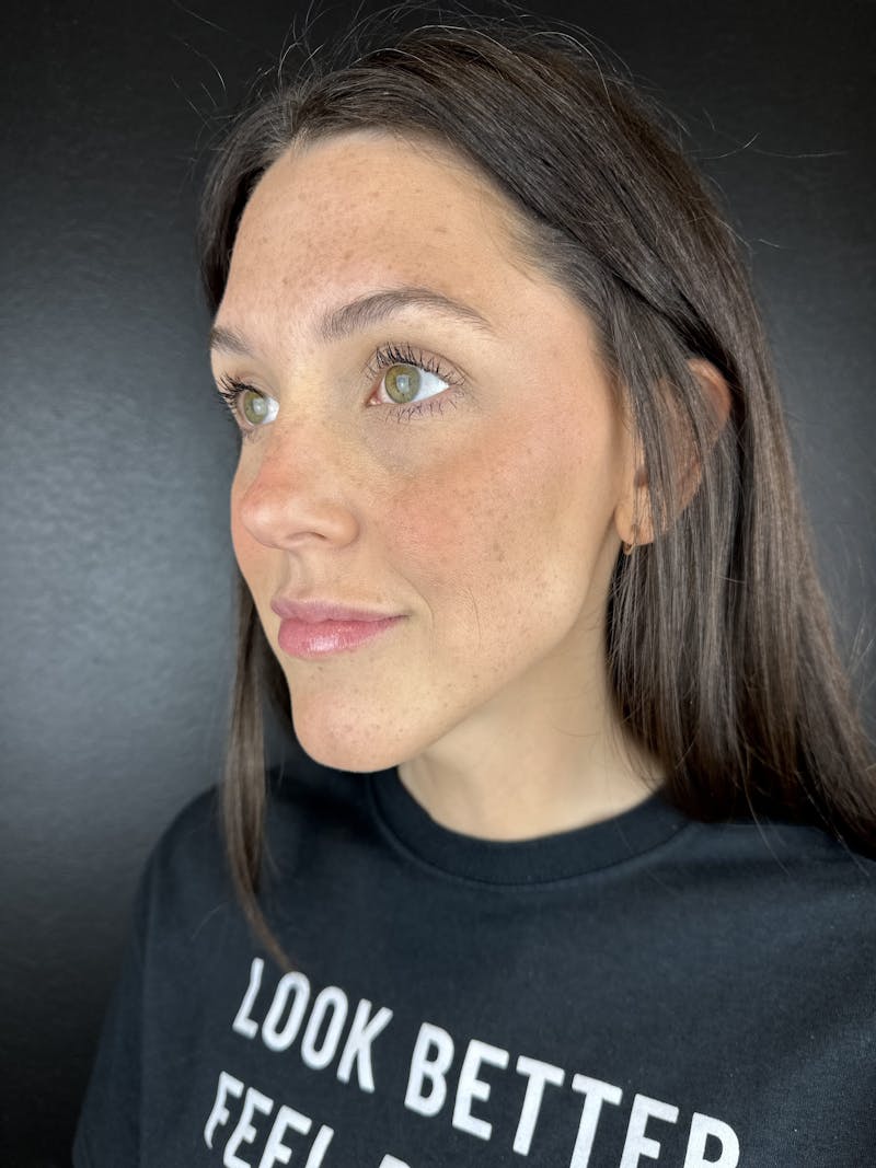 Full Facial Filler Before & After Gallery - Patient 353003 - Image 2