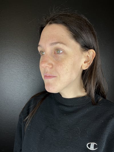 Full Facial Filler Before & After Gallery - Patient 353003 - Image 1