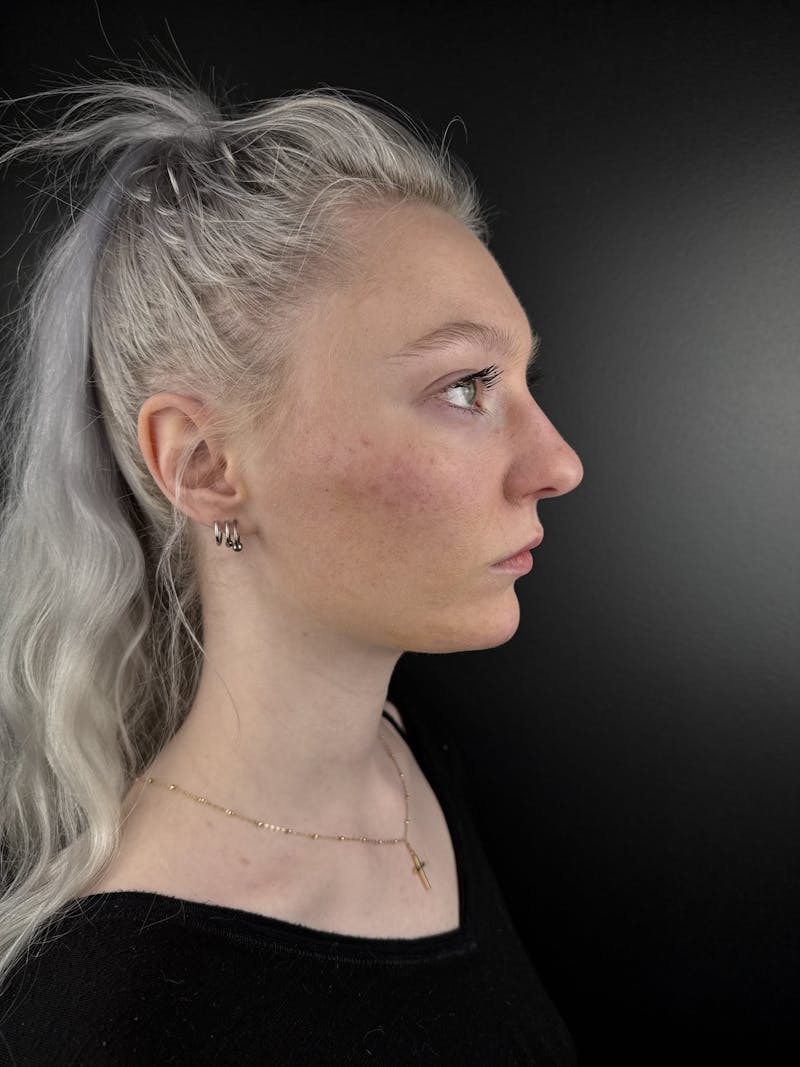 Full Facial Filler Before & After Gallery - Patient 190222 - Image 4