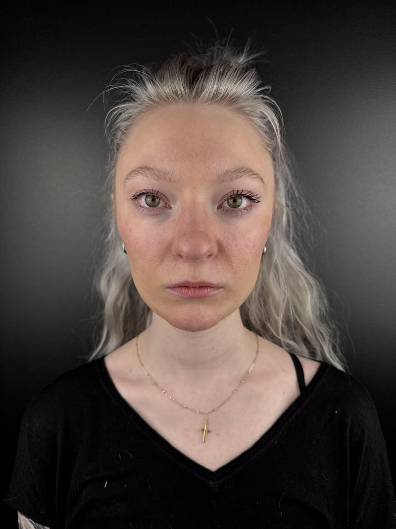 Full Facial Filler Before & After Gallery - Patient 190222 - Image 2