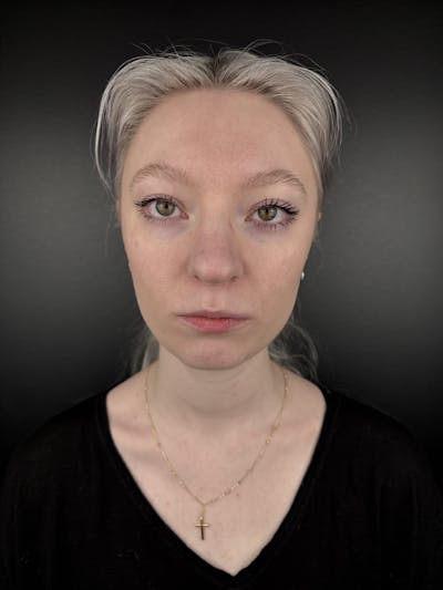 Full Facial Filler Before & After Gallery - Patient 190222 - Image 1