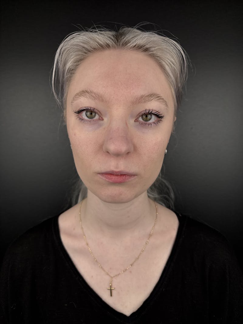 Full Facial Filler Before & After Gallery - Patient 190222 - Image 1
