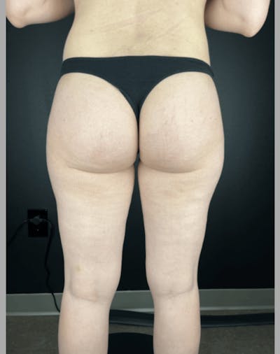 Body Contouring Before & After Gallery - Patient 219811 - Image 2