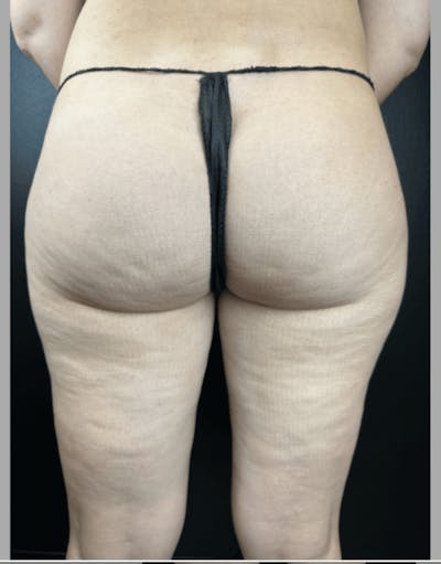 Body Contouring Before & After Gallery - Patient 219811 - Image 1
