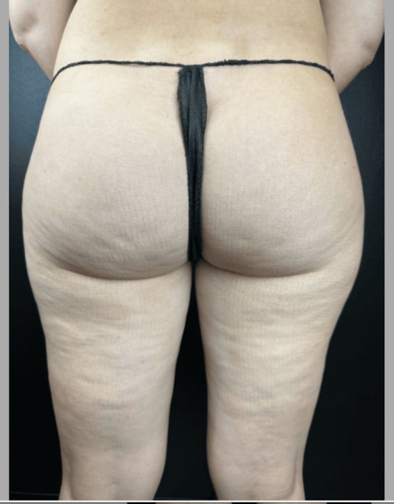 Body Contouring Before & After Gallery - Patient 219811 - Image 1