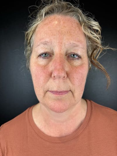 Laser Resurfacing Before & After Gallery - Patient 231024 - Image 1