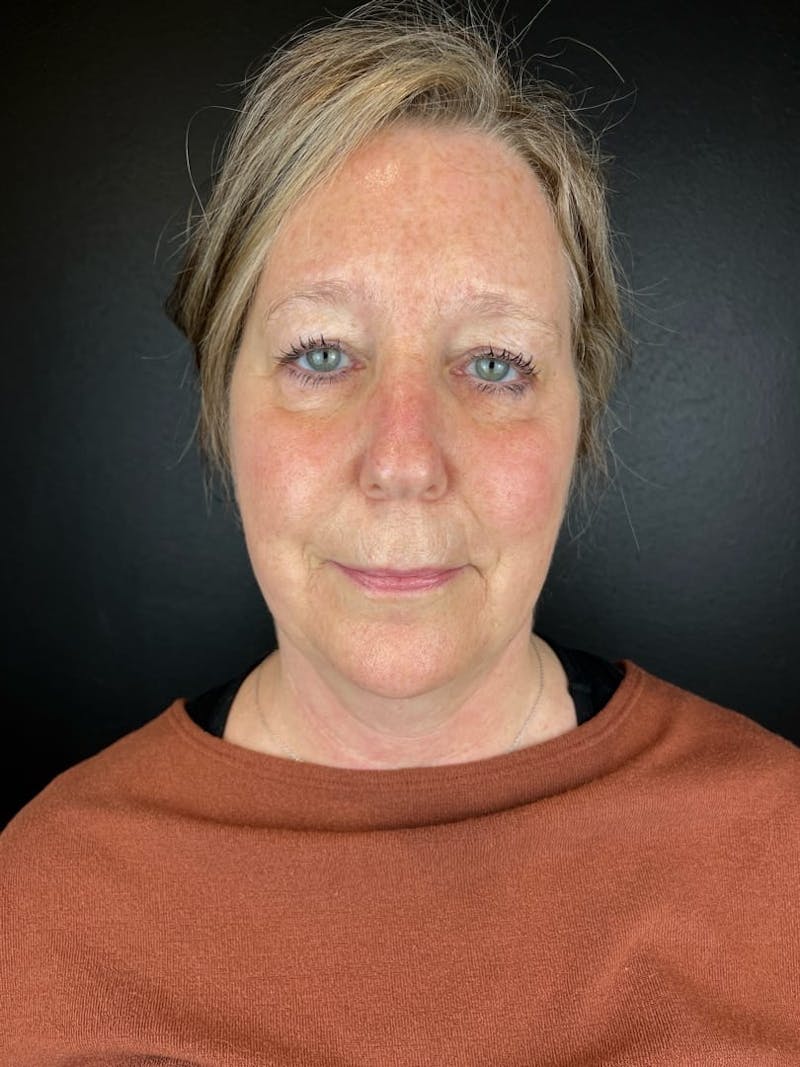 Laser Resurfacing Before & After Gallery - Patient 231024 - Image 2