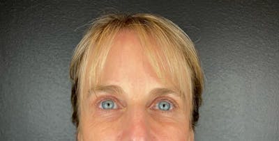 Laser Resurfacing Before & After Gallery - Patient 399882 - Image 1