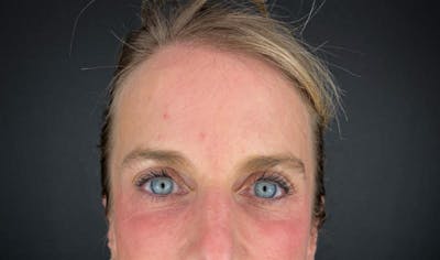 Laser Resurfacing Before & After Gallery - Patient 399882 - Image 2