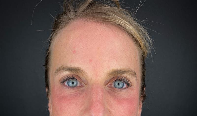 Laser Resurfacing Before & After Gallery - Patient 399882 - Image 2