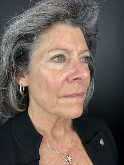 Laser Resurfacing Before & After Gallery - Patient 232036 - Image 2