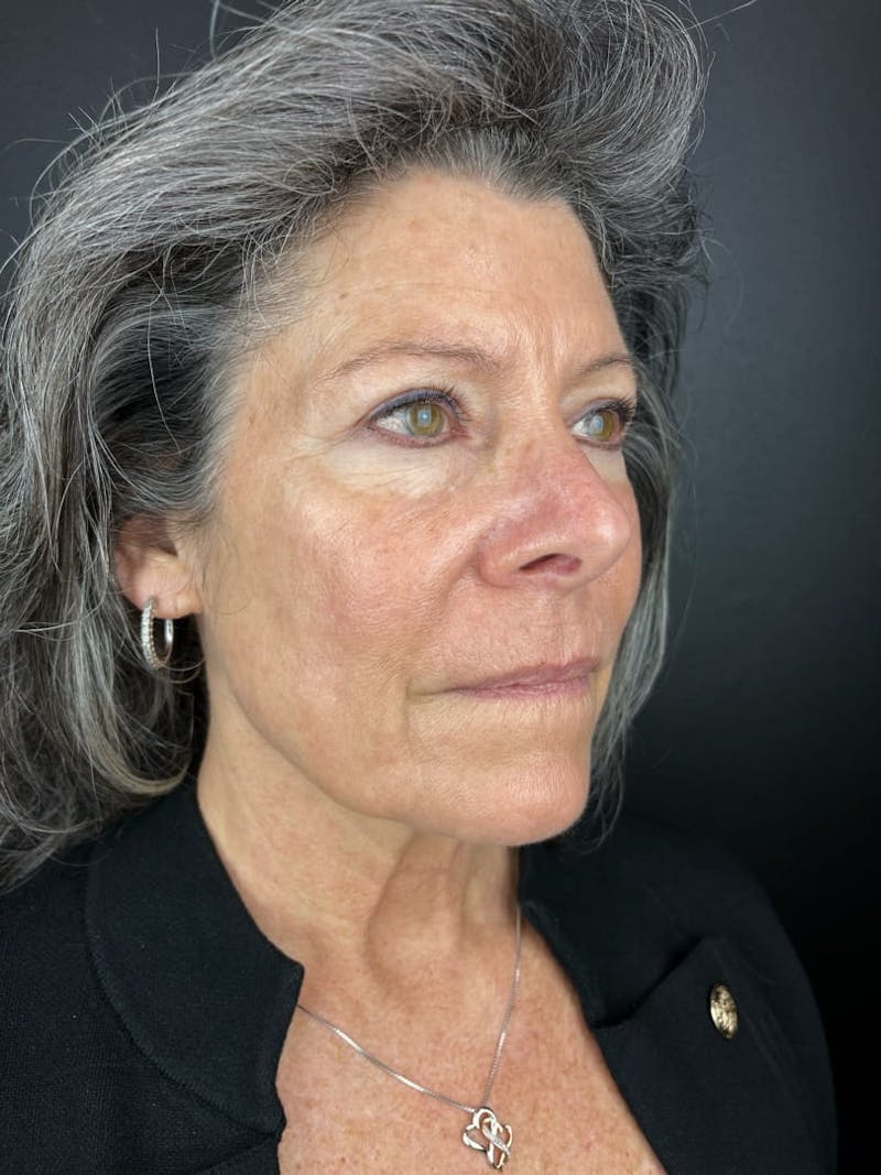 Laser Resurfacing Before & After Gallery - Patient 232036 - Image 2