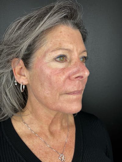 Laser Resurfacing Before & After Gallery - Patient 232036 - Image 1