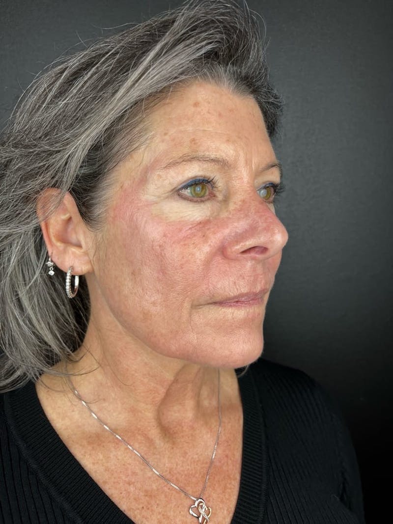 Laser Resurfacing Before & After Gallery - Patient 232036 - Image 1