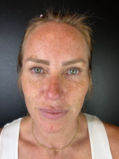 Laser Resurfacing Before & After Gallery - Patient 376559 - Image 1
