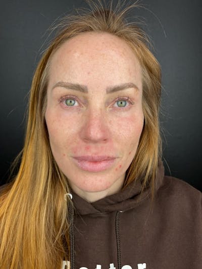 Laser Resurfacing Before & After Gallery - Patient 376559 - Image 2