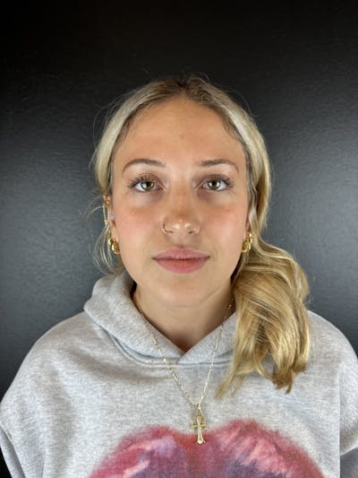 Lip Filler Before & After Gallery - Patient 181441 - Image 1
