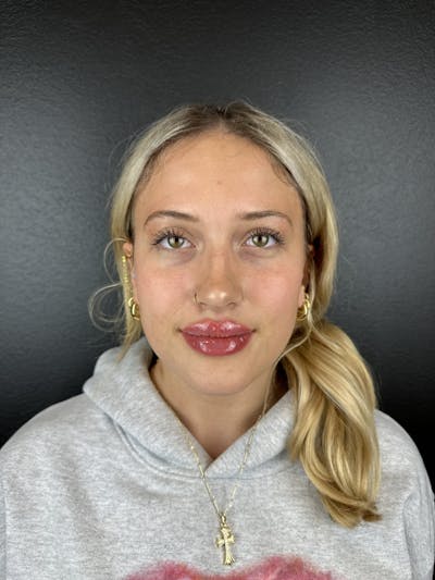 Lip Filler Before & After Gallery - Patient 181441 - Image 2