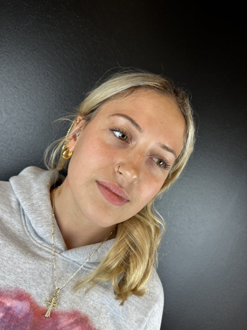 Lip Filler Before & After Gallery - Patient 181441 - Image 3