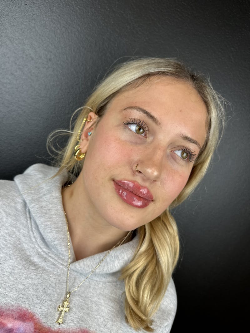 Lip Filler Before & After Gallery - Patient 181441 - Image 4