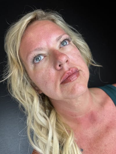 Lip Filler Before & After Gallery - Patient 209054 - Image 2