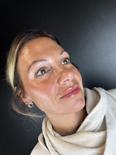 Lip Filler Before & After Gallery - Patient 202802 - Image 2