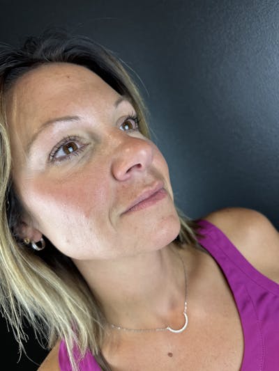 Lip Filler Before & After Gallery - Patient 202802 - Image 1