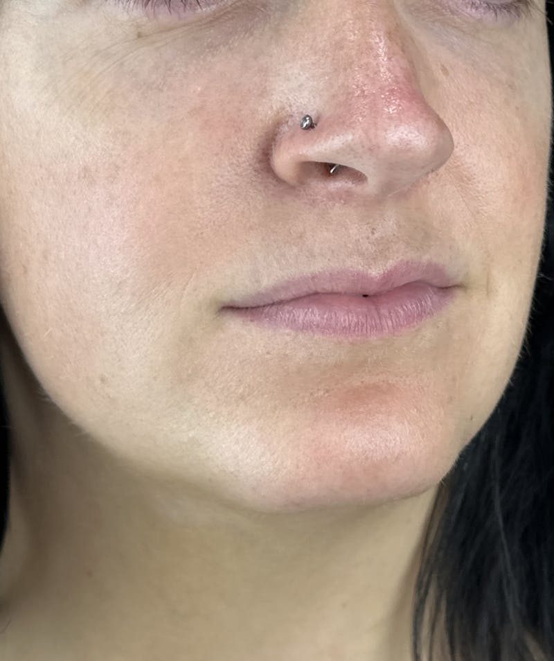 Lip Filler Before & After Gallery - Patient 134104 - Image 5