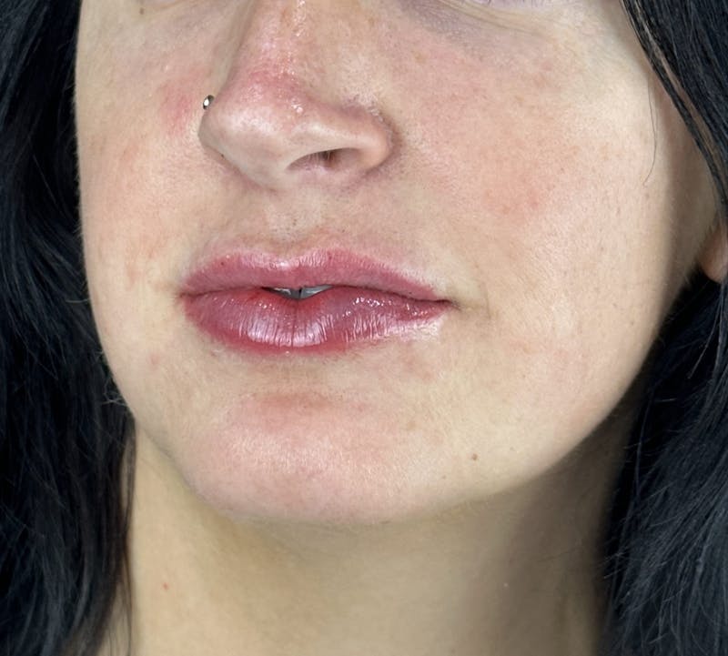 Lip Filler Before & After Gallery - Patient 134104 - Image 8