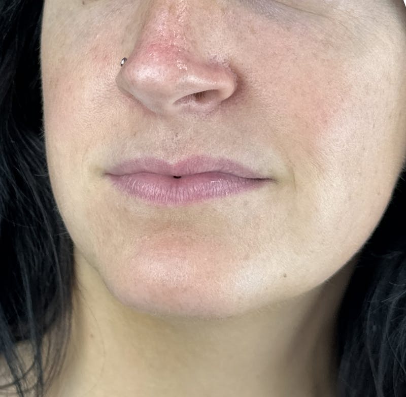 Lip Filler Before & After Gallery - Patient 134104 - Image 7