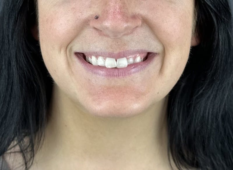 Lip Filler Before & After Gallery - Patient 134104 - Image 3