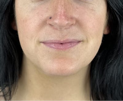 Lip Filler Before & After Gallery - Patient 134104 - Image 1