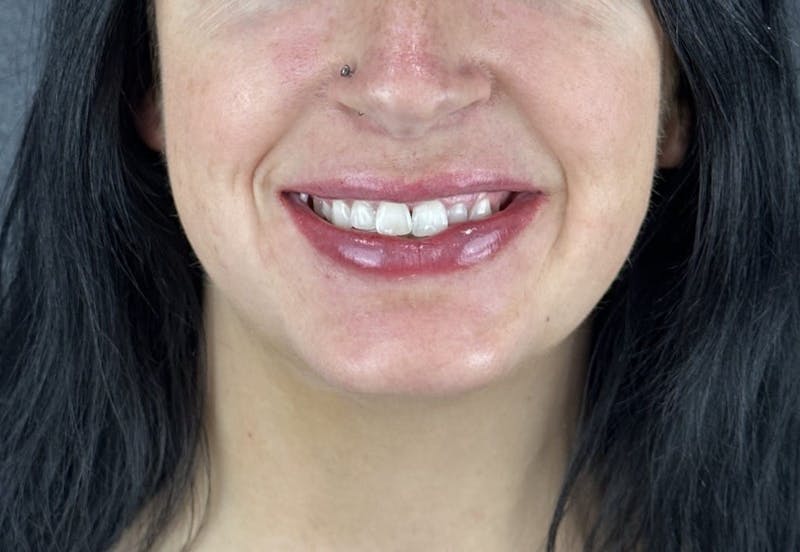 Lip Filler Before & After Gallery - Patient 134104 - Image 4