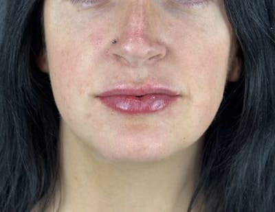 Lip Filler Before & After Gallery - Patient 134104 - Image 2