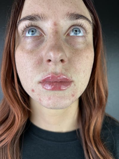 Lip Filler Before & After Gallery - Patient 903470 - Image 2