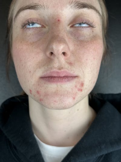 Lip Filler Before & After Gallery - Patient 903470 - Image 1