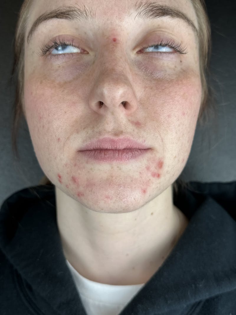 Lip Filler Before & After Gallery - Patient 903470 - Image 1