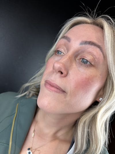 Lip Filler Before & After Gallery - Patient 214210 - Image 1