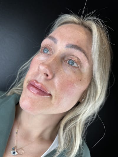 Lip Filler Before & After Gallery - Patient 214210 - Image 2
