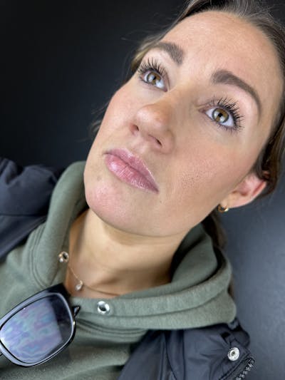 Lip Filler Before & After Gallery - Patient 953424 - Image 1