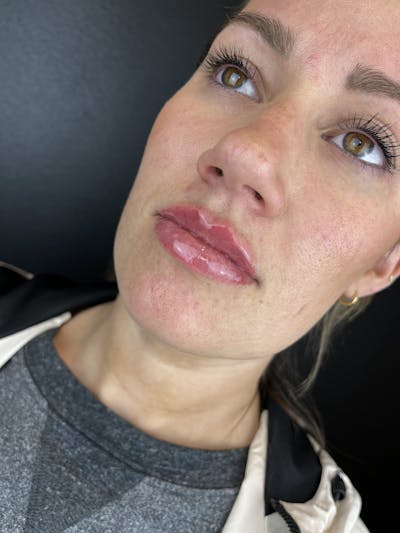 Lip Filler Before & After Gallery - Patient 953424 - Image 2