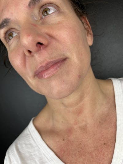 Lip Filler Before & After Gallery - Patient 862820 - Image 1